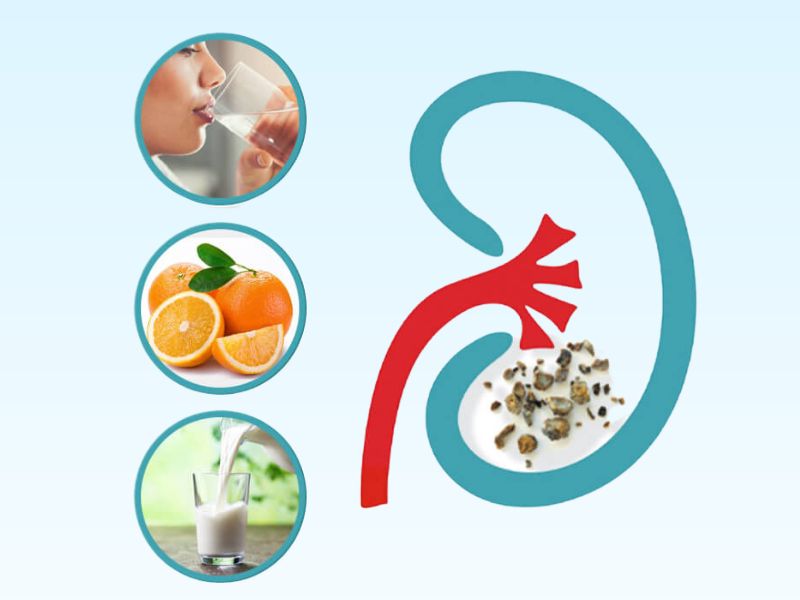 5 Habits for Prevention of Kidney Stones