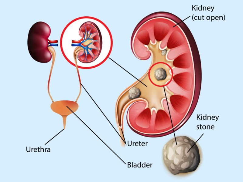Signs That You May Have Kidney Disease
